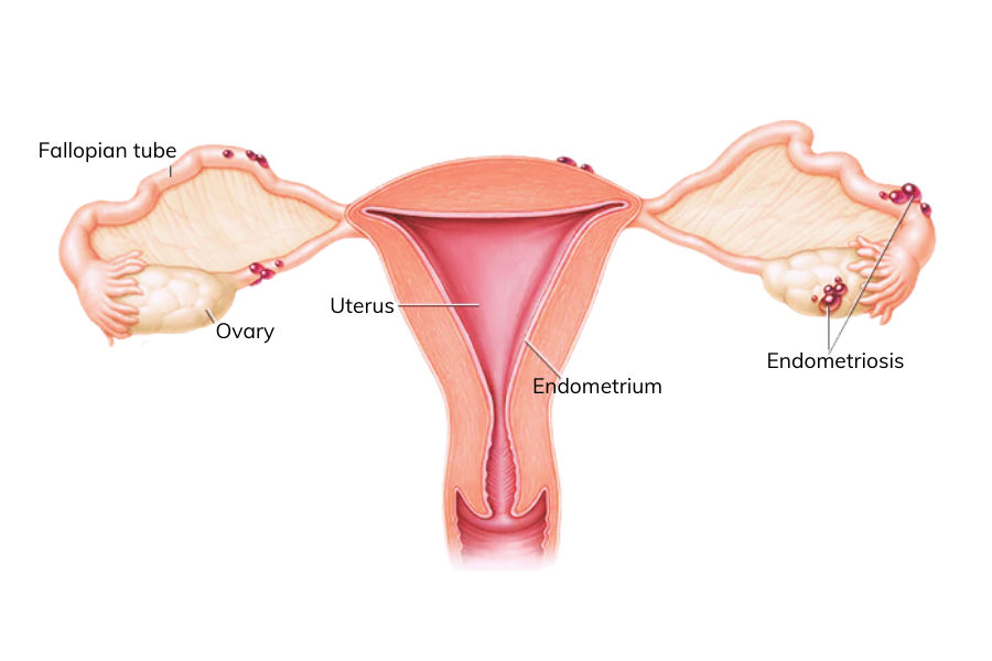 A diagram to show endometriosis