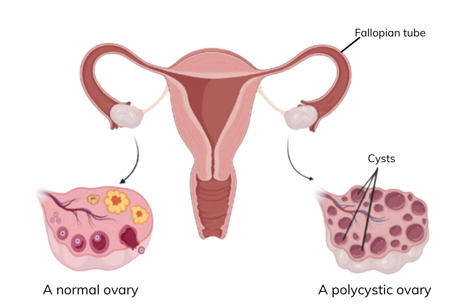 A diagram to show the difference between a pcos ovary with a normal ovary