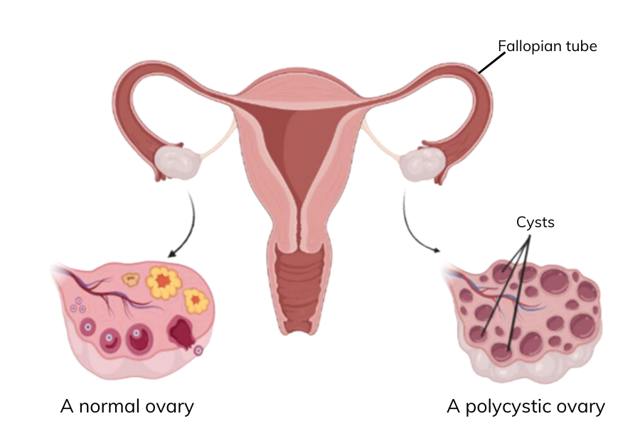 A diagram to show the difference between a pcos ovary with a normal ovary