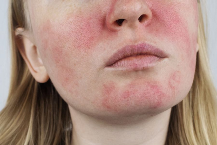 What can Rosacea look like