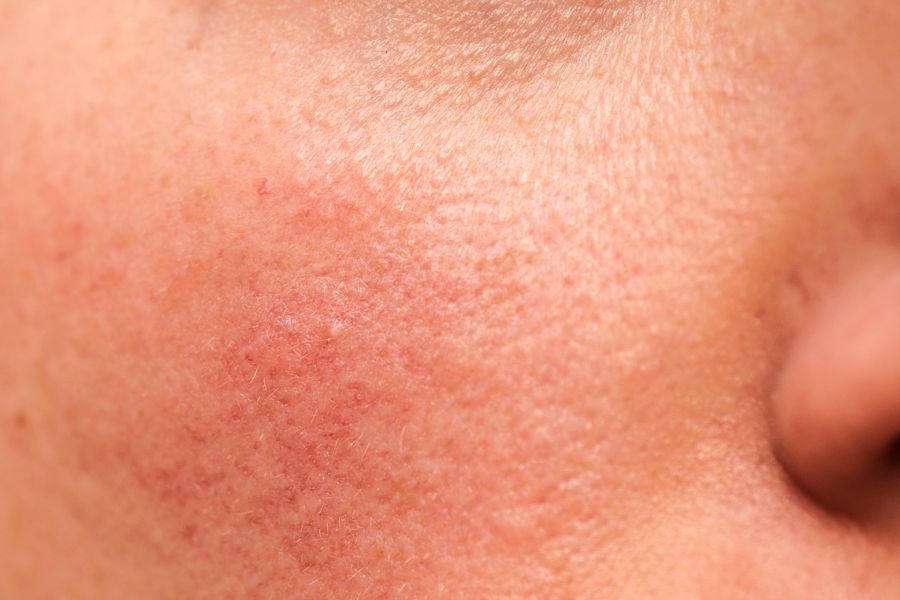 an example of skin affected by internal inflammation