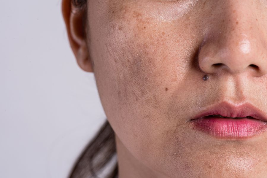 caudalie vinoperfect serum before and after