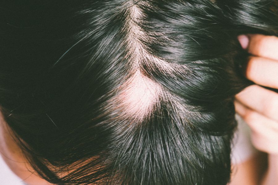 collagen for hair loss