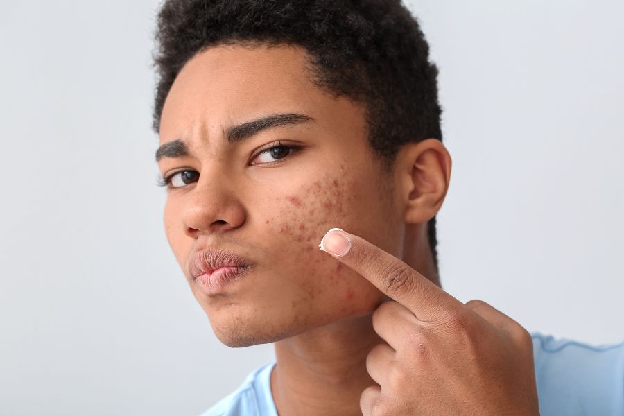 Acne: What Could be Causing Your Breakouts Blog