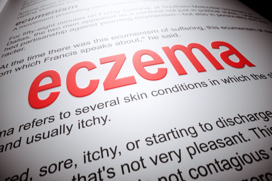 Non-Steroidal Treatment Alternatives For Eczema blog image