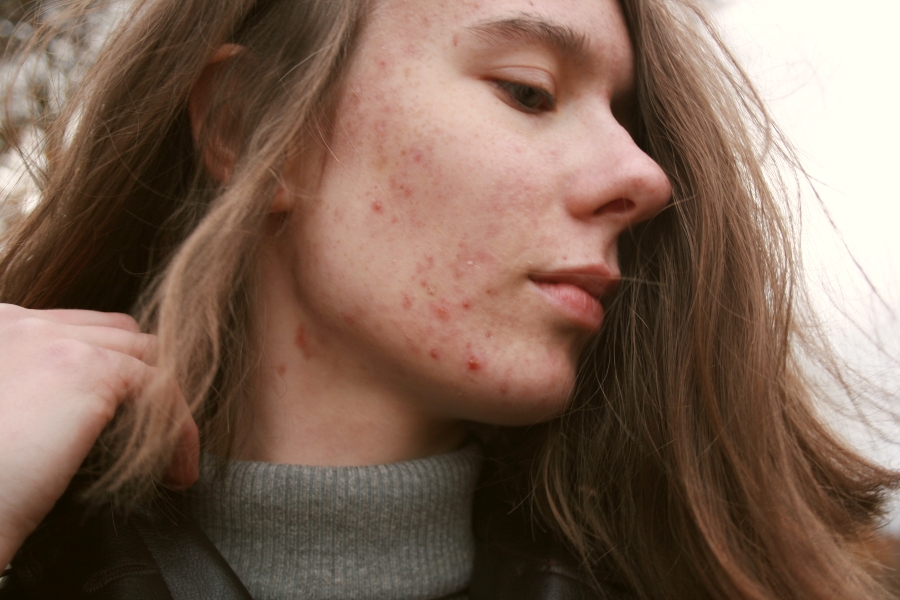 Can Moisturiser Actually Help Clear Up Acne?