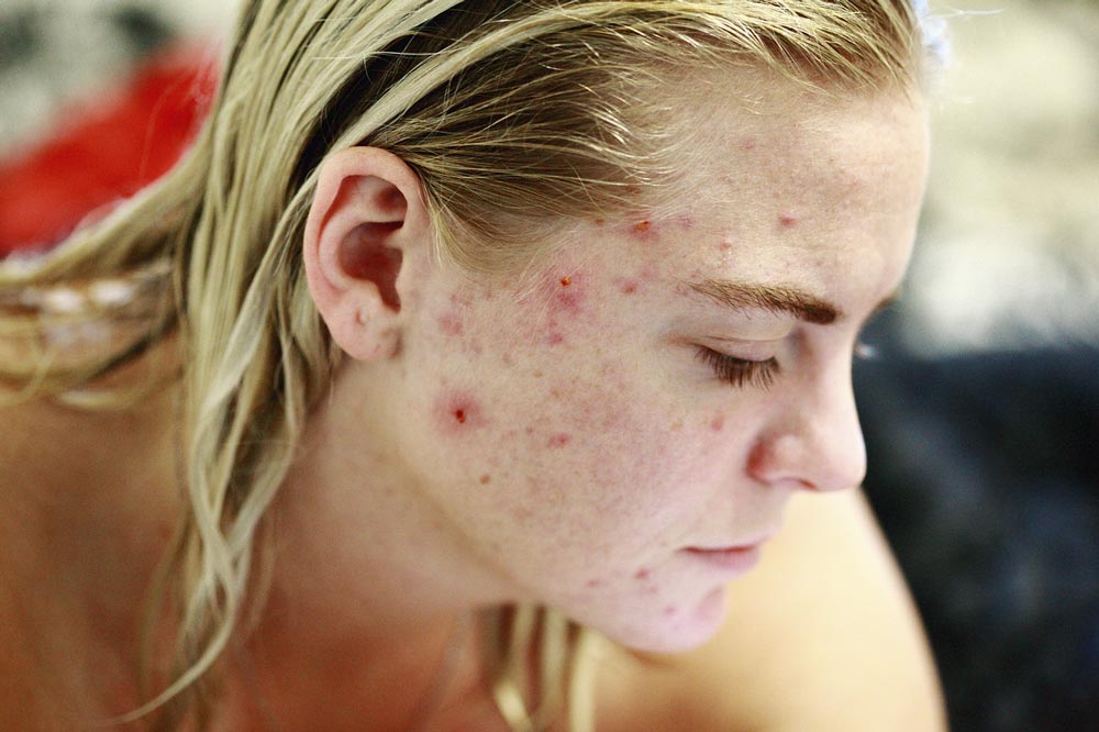 Woman with acne outbreak