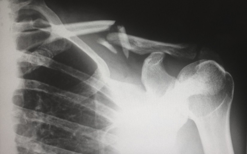x-ray of broken shoulder bone