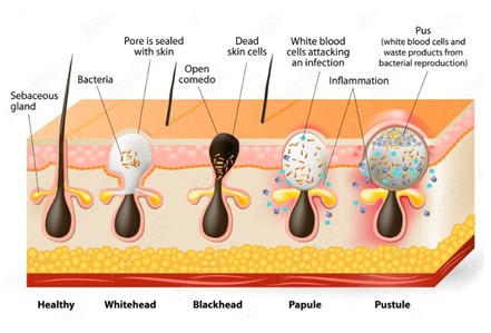 Acne Types Diagram