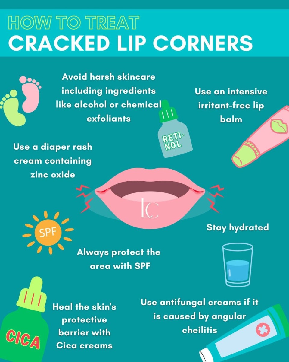 how to get rid of dry cracked lip corners fast at home