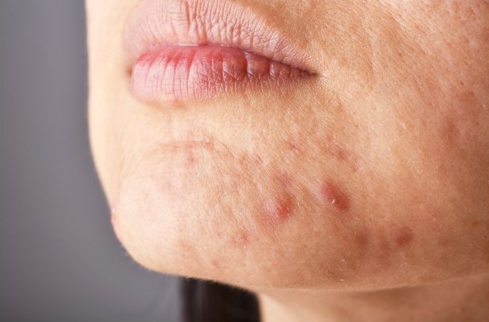 pregnancy acne