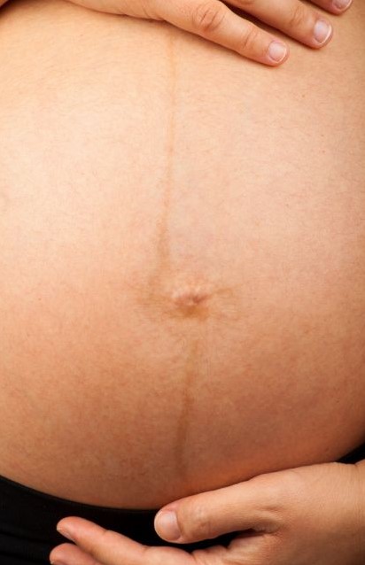 Pregnancy Linea Nigra