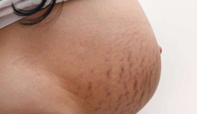 pregnancy stretch marks