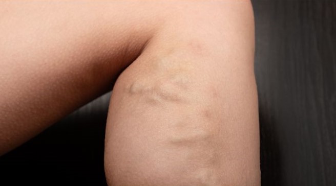 Varicose Veins